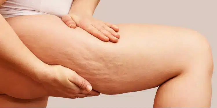how to reduce cellulite