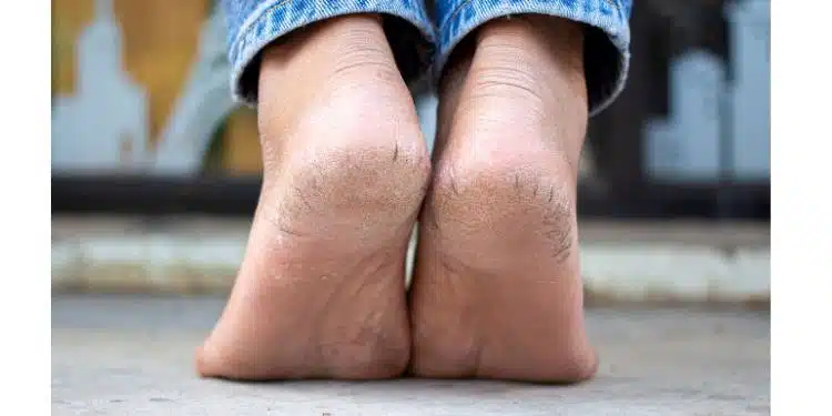 treatment for dry cracked heels